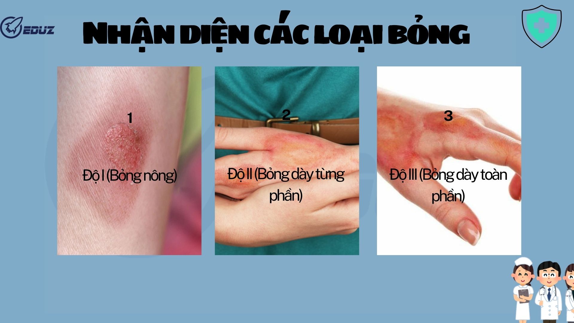 2. Nhận diện các loại bỏng